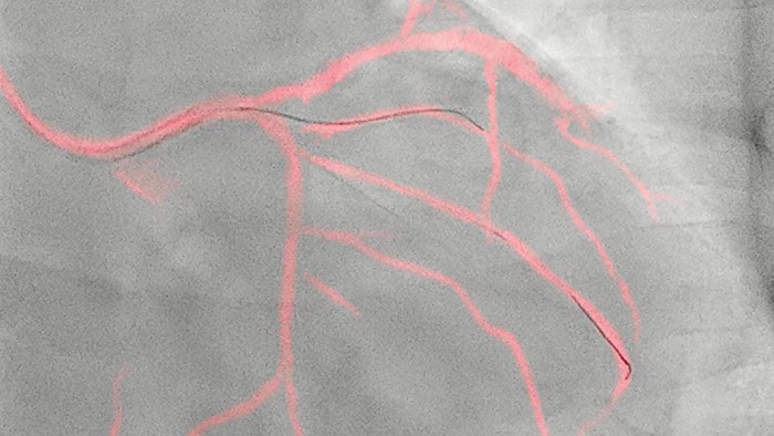Philips’ image-guided navigation increases safety during coronary interventions and reduces the use of contrast media by an average of 28.8%