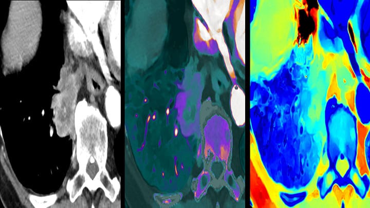 Conventional and spectral CT lung lesion data