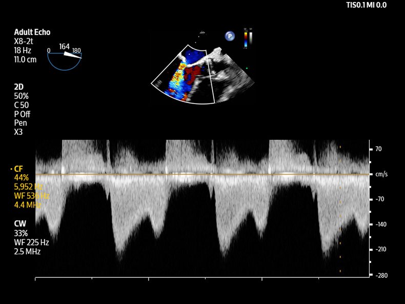 Philips Flash 5100 mitral valve clinical image